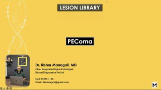 Pathology of PEComa [upl. by Sad]