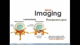 Imaging of postoperative spine DRE Prof Mamdouh Mahfouz [upl. by Leahcimrej]