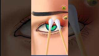 ASMR green Eye piercing swelling redness amp Mega worm treatment 2d animation [upl. by Monney]