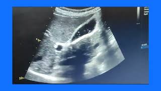 Empyema gallbladder or pyocele or suppurative cholecystitis ultrasound and color Doppler video [upl. by Felicidad751]