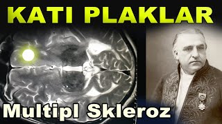 Multipl Skleros  Disease Sclérose Plaques [upl. by Adnohrahs118]