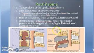 Pathology 825 h TB Spondylitis Tuberculous Osteomyelitis Potts Spine Disease disc body bone [upl. by Nyletak442]