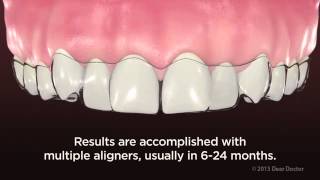 ClearPath Aligners  NEW VIDEO for PATIENT EDUCATION by AACD [upl. by Neelyk31]