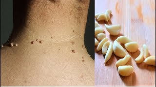 Remove Skin Tags  Home Remedies To Remove Skin Tags Easily [upl. by Shandee]