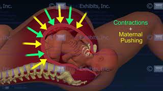 Shoulder Dystocia [upl. by Kassi]