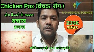 chicken pox in Hindi चेचक रोग  छोटी माता ओर बड़ी माता रोग ओर बचाव  symptoms and Treatment  RDMS [upl. by Baoj]