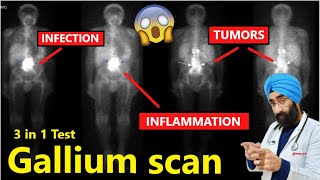 What is Gallium scan  Test to looks for infection inflammation and tumors  DrEducation [upl. by Harwilll218]