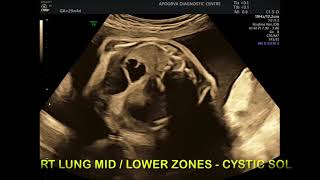 Ultrasound target scan  Abnormal lungs sonography [upl. by Mehs294]