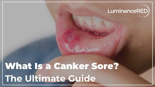 What Is a Canker Sore The Ultimate Guide [upl. by Ahsatal]