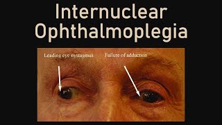 Internuclear Ophthalmoplegia [upl. by Haelat]