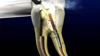 Removal of a Post Using Ultrasonics [upl. by Eiralam]