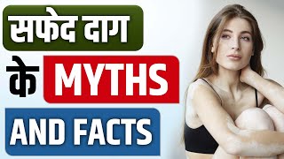 Vitiligo Tips  सफेद दाग के Myths And Facts  Safed Daag Ka Ilaaj  How to cure vitiligo on face [upl. by Nikoletta]