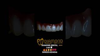 dentaltechnician zirconia hollywoodsmile emax ابتسامةهوليود هوليودسمايل تركيا smile [upl. by Mhoj]