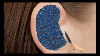 Itchy  Ear Stone Removal  Super Big Earwax  ASMR Animation TalesOfTingles [upl. by Ellicec]