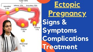 Ectopic Pregnancy In Hindi  Ectopic Pregnancy क्या होती है लक्षण और कारण क्या है [upl. by Bullen]