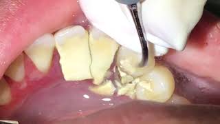 Houston Cosmetic DentistTartar Tartar Tartar How we remove it [upl. by Eveneg]