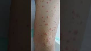 Guttate psoriasis  psoriasis skin psoriasisawareness psoriasissolution dermestidscanada short [upl. by Yxor]