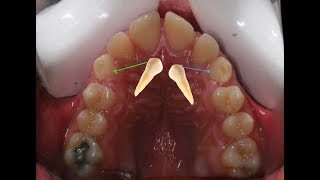 Orthodontic treatment of bilateral palataly deep impacted canines Yazan 14 yrs [upl. by Acinehs475]