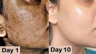 Repair Damaged Skin  Close Large OPEN PORES amp Remove Dark spots Hyper pigmentation with Potato [upl. by Pleasant788]