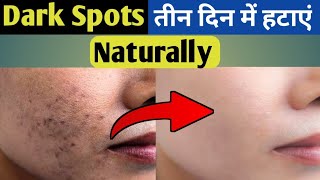 Dark Spots on Face Removal  Dark Spots kaise hataye  Dark Spots Removal [upl. by Snider]