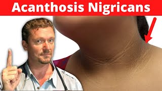 What is Acanthosis Nigricans Its NOT Dirty Neck Its a Sign Dark Underarms [upl. by West]