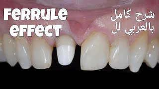 ferrule effect شرح كامل بالعربي لل [upl. by Bianca274]