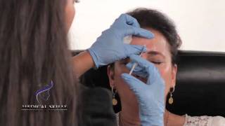 Botulinum Toxin  Injection Technique [upl. by Aiker]