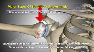 5 Major Types of Shoulder Arthritis Osteoarthritis Rheumatoid Septic Gout Pseudogout [upl. by Woolson]