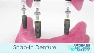 Demo How Do SnapIn Dentures With Implants Work [upl. by Senoj946]