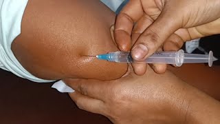 IM Intramuscular Arm injection Push Ketorolac  Xerokit  injection Ep 34 Injection Vision [upl. by Edgerton]