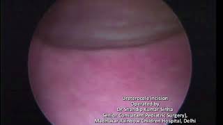 cystoscopic ureterocele incision Dr Shandip Sinha Pediatric surgeon and urologist [upl. by Fredericka]