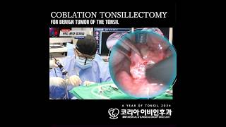 편도 종양과 편도 절제술 coblation tonsillectomy with tumor removal [upl. by Kcirdahc822]