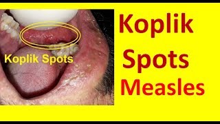 Koplik Spots in Measles [upl. by Nayab]