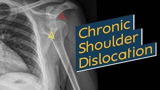 Chronic Shoulder Dislocation [upl. by Dukey]