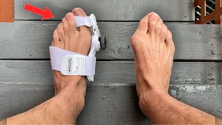 I Tried a Bunion Corrector Heres What Happened [upl. by Retlaw]