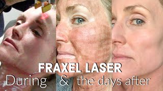 My FRACTIONAL CO2 LASER Experience  The FULL Treatment amp the DAYS following  BEFORE amp AFTER Fraxel [upl. by Nevah]