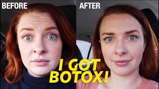 I Got Botox My Experience with Dr Dhir  Before and After [upl. by Leggat]