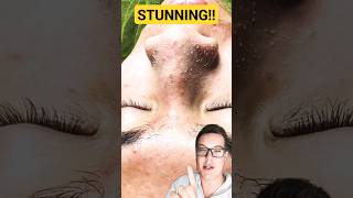 ULTIMATE PORE STRIP REMOVAL  How To Prep Skin For Pore Strips shorts [upl. by Elnar]