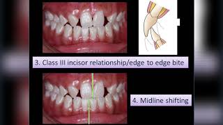 An interdisciplinary care of multiple congenitally missing teeth [upl. by Nainatrad]