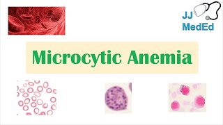 Microcytic Anemia amp Causes Iron Deficiency Thalassemia Anemia of Chronic Disease Lead Poisoning [upl. by Kristoffer]