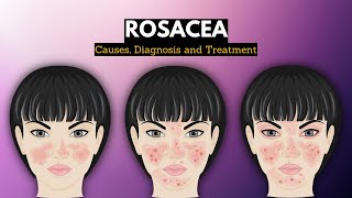 Rosacea Causes Signs and Symptoms Diagnosis and Treatment [upl. by Letnom]