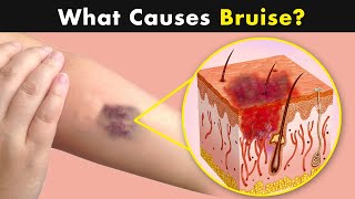 Bruises  Why does it happens  Symptoms Causes and treatment UrduHindi [upl. by Cynthia]