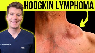 Doctor explains WARNING SYMPTOMS and SIGNS of HODGKINS LYMPHOMA CANCER [upl. by Liborio234]