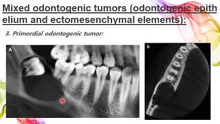 Odontogenic Tumors section 2  DR NOOR SAHBAN FOURTH GRADE [upl. by Adiam220]