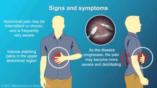 Chronic Pancreatitis [upl. by Yssenhguahs409]