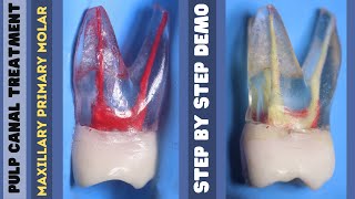 Pulp Canal Treatment 🟡 Maxillary Primary Molar 🔵 step by step demonstration [upl. by Lalittah463]