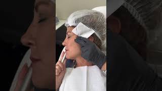 PDO Thread Lift  Elite Medical SPA  Cosmetic Procedures in Boca Raton FL [upl. by Werra556]