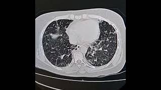 Subacute nonspecific interstitial pneumonia Alveolar proteinosis [upl. by Vivianna785]