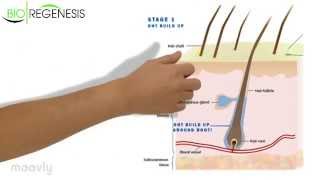 Alopecia Androgenética Hereditaria [upl. by Rudman]