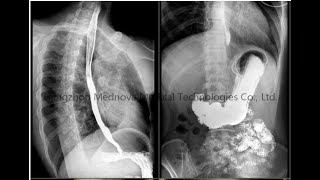 Fluoroscopy image from Digital Fluoroscopy amp Radiography system [upl. by Devol]